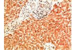 Immunohistochemical analysis of paraffin-embedded Human Liver Carcinoma Tissue using Collagen IV  Mouse mAb diluted at 1:200.