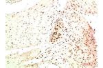 Immunohistochemical analysis of paraffin-embedded Human Colon Carcinoma Tissue using HP-1 a  Mouse mAb diluted at 1:200.