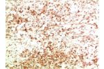 Immunohistochemical analysis of paraffin-embedded Human Ovarian Carcinoma Tissue using ATG5  Mouse mAb diluted at 1:200.