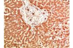 Immunohistochemical analysis of paraffin-embedded Human Liver Carcinoma Tissue using Collagen IV  Mouse mAb diluted at 1:200.