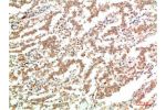 Immunohistochemical analysis of paraffin-embedded Human Lung Carcinoma Tissue using JAK2  Mouse mAb diluted at 1:200.