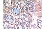 Immunohistochemical analysis of paraffin-embedded Human Breast Carcinoma Tissue using Bax Mouse mAb diluted at 1:200.