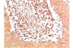 Immunohistochemical analysis of paraffin-embedded Human Lung Carcinoma Tissue using Collagen II  Mouse mAb diluted at 1:200.