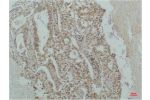 Immunohistochemical analysis of paraffin-embedded Human Lung Carcinoma using I?B 