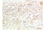 Immunohistochemical analysis of paraffin-embedded Human Lung Carcinoma Tissue using Collagen II  Mouse mAb diluted at 1:200.