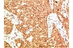 Immunohistochemical analysis of paraffin-embedded Human Breast Carcinoma Tissue using Acetyl NF kB P65(K314/K315)  Mouse mAb diluted at 1:200.