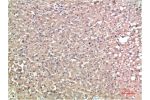 Immunohistochemical analysis of paraffin-embedded Human Liver Carcinoma Tissue using TTR Mouse mAb diluted at 1:200.