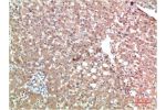Immunohistochemical analysis of paraffin-embedded Human Liver Carcinoma Tissue using TTR Mouse mAb diluted at 1:200.