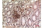 Immunohistochemical analysis of paraffin-embedded Human Colon CarcinomaTissue using Epsilon Tubulin Mouse mAb diluted at 1:200.