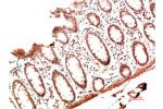 Immunohistochemical analysis of paraffin-embedded Human Colon Carcinoma Tissue using Collagen I  Mouse mAb diluted at 1:200.