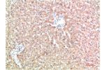 Immunohistochemical analysis of paraffin-embedded Human Liver Carcinoma Tissue using TTR Mouse mAb diluted at 1:200.