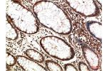 Immunohistochemical analysis of paraffin-embedded Human Colon Carcinoma Tissue using ATM Mouse mAb diluted at 1:200.
