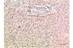 Immunohistochemical analysis of paraffin-embedded Human Liver Carcinoma Tissue using TTR Mouse mAb diluted at 1:200.