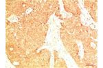 Immunohistochemical analysis of paraffin-embedded Human Breast Carcinoma Tissue using Acetyl P53(K382)  Mouse mAb diluted at 1:200.