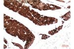 Immunohistochemical analysis of paraffin-embedded Human Colon Carcinoma Tissue using Muscle Actin Mouse mAb diluted at 1:200.