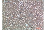 Immunohistochemical analysis of paraffin-embedded Human Liver Carcinoma Tissue using TTR Mouse mAb diluted at 1:200.
