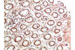 Immunohistochemical analysis of paraffin-embedded Human Colon Carcinoma Tissue using Collagen II Mouse mAb diluted at 1:500