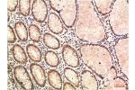 Immunohistochemical analysis of paraffin-embedded Human Colon Carcinoma Tissue using ATM Mouse mAb diluted at 1:200.
