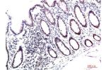 Immunohistochemical analysis of paraffin-embedded Human Colon Carcinoma Tissue using HP-1?  Mouse mAb diluted at 1:200.