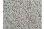 Immunohistochemical analysis of paraffin-embedded Human Breast Carcinoma using TBP/TATA Binding Protein(mAb diluted at 1:200.