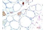 Immunohistochemical analysis of paraffin-embedded Human Liver Carcinoma Tissue using TTR Mouse mAb diluted at 1:200.