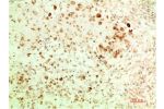 Immunohistochemical analysis of paraffin-embedded Human Ovarian Carcinoma Tissue using ATG5  Mouse mAb diluted at 1:200.