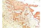 Immunohistochemical analysis of paraffin-embedded Human Breast Carcinoma Tissue using Acetyl P53(K382)  Mouse mAb diluted at 1:200.