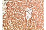 Immunohistochemical analysis of paraffin-embedded Human Liver Carcinoma Tissue using Collagen IV  Mouse mAb diluted at 1:200.