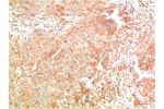 Immunohistochemical analysis of paraffin-embedded Human Breast Carcinoma Tissue using ATG7  Mouse mAb diluted at 1:200.