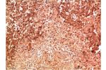 Immunohistochemical analysis of paraffin-embedded Human Lung Carcinoma Tissue using P38  Mouse mAb diluted at 1:200.