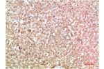 Immunohistochemical analysis of paraffin-embedded Human Liver Carcinoma Tissue using TTR Mouse mAb diluted at 1:200.