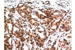 Immunohistochemical analysis of paraffin-embedded Human Breast CarcinomaTissue using Ubiquitin Mouse mAb diluted at 1:200.