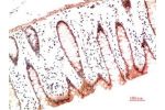 Immunohistochemical analysis of paraffin-embedded Human Colon Carcinoma Tissue using Collagen I  Mouse mAb diluted at 1:200.
