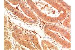 Immunohistochemical analysis of paraffin-embedded Human Colon Carcinoma Tissue using Acetyl P53(K382)  Mouse mAb diluted at 1:200.