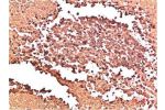 Immunohistochemical analysis of paraffin-embedded Human Lung Carcinoma Tissue using Collagen II  Mouse mAb diluted at 1:200.