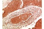 Immunohistochemical analysis of paraffin-embedded Human Breast Carcinoma Tissue using JAK2  Mouse mAb diluted at 1:200.