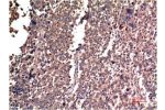 Immunohistochemical analysis of paraffin-embedded Human Lung Carcinoma Tissue using Cyclin B1 Mouse mAb diluted at 1:200.
