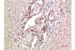 Immunohistochemical analysis of paraffin-embedded Human Liver Carcinoma Tissue using TTR Mouse mAb diluted at 1:200.