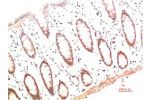 Immunohistochemical analysis of paraffin-embedded Human Colon Carcinoma Tissue using Collagen I  Mouse mAb diluted at 1:200.