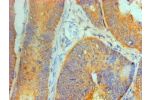 Immunohistochemical of paraffin-embedded Human Colon cancer tissue using CSB-MA8378691A0m at dilution of 1:200.
