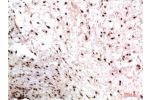 Immunohistochemical analysis of paraffin-embedded Human Colon Carcinoma Tissue using HP-1?  Mouse mAb diluted at 1:200.