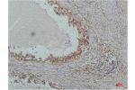 Immunohistochemical analysis of paraffin-embedded Human Lung Carcinoma using I?B 