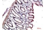 Immunohistochemical analysis of paraffin-embedded Human Colon Carcinoma Tissue using HP-1?  Mouse mAb diluted at 1:200.