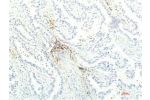 Immunohistochemical analysis of paraffin-embedded Human Lung Carcinoma Tissue using JAK1 Mouse mAb diluted at 1:200.