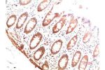 Immunohistochemical analysis of paraffin-embedded Human Colon Carcinoma Tissue using Collagen I  Mouse mAb diluted at 1:200.