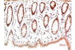 Immunohistochemical analysis of paraffin-embedded Human Colon Carcinoma Tissue using Collagen I  Mouse mAb diluted at 1:200.