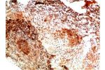 Immunohistochemical analysis of paraffin-embedded Human Lung Carcinoma Tissue using Collagen II  Mouse mAb diluted at 1:200.
