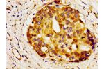 Immunohistochemistry of paraffin-embedded human breast cancer using CSB-PA001001LA01HU at dilution of 1:100