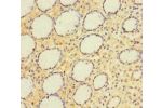 Immunohistochemistry of paraffin-embedded human gastric cancer using CSB-PA001009LA01HU at dilution of 1:100