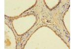 Immunohistochemistry of paraffin-embedded human prostate cancer using CSB-PA001014LA01HU at dilution of 1:100
